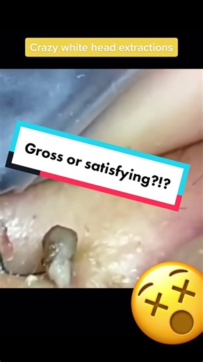 Whitehead extarctions. #whiteheadextraction #extractions #weirdlysatisfying #zitpopper #acnetreatment #pimplepopping_addiction