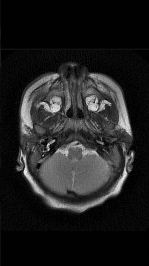 Dyke-Davidoff-Masson Syndrome MRI #shorts