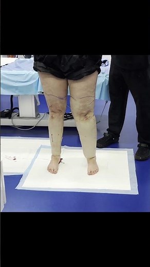 Unreal Before & After! 🌟 Lipedema Leg Liposuction LIVE SURGERY with Dr. Thomas Su | Tampa, Florida 🌴