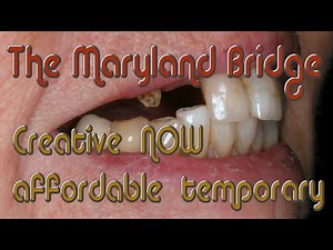 Same-Day Maryland Bridge For Missing Front Teeth