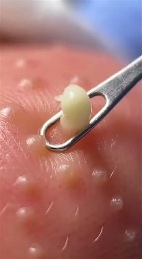 Chin Whiteheads Pop Fast — Most Satisfying Skincare Video