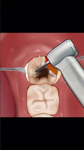 ASMR Wisdom tooth animation P3 #shorts