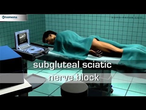 Subgluteal Sciatic Nerve Block
