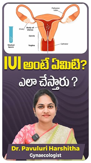 What is IUI Treatment for Pregnancy | Step by Step Procedure |#shorts #healthtips #iui #iuitreatment