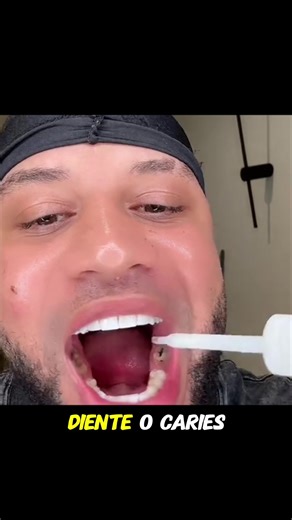 #cavity #teethhealth #yellowteeth #tiktokshop #fyp