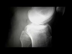 Leg fracture - X-Ray Bones - Creative Commons Stock Video