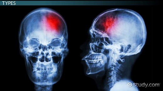 What is a Hematoma? - Definition, Types, Symptoms & Treatment