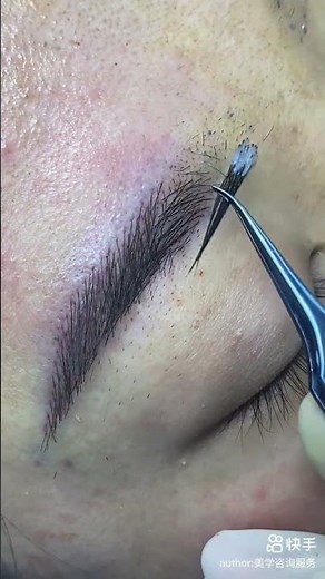Eyebrow Transplant Close-Up! Watch Real Hair Grafting in Action 🔍✨