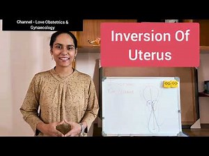 Management Of Uterine Inversion- 3rd Stage Labour Complication ‎@Love_Obs_Gynae
