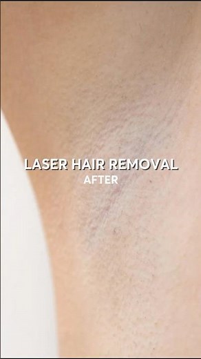 Laser Hair Removal: Before & After