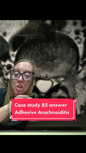 Case study 85 - Adhesive Arachnoiditis @Ladyspinedoc | Dr. Grunch 🧠 Arachnoiditis is a rare pain disorder caused by inflammation of the arachnoid, one of the membranes that surrounds the nerves of your spinal cord. It can cause severe pain and neurological symptoms, such as muscle weakness. Arachnoiditis has several possible causes, and treatment is aimed at managing symptoms. #neurosurgery #casestudy #sundaycasestudy #ladyspinedoc #healthcareworker #hospital #surgery #neurosurgeon #medicalscho