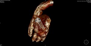 Earth Ancients Special Edition. (3/25/24) The Hybrid Humans of Nazca Peru with Michael Mazzola. Image: Child hybrid, Santiago Podcast link: https://www.spreaker.com/episode/special-edition-the-hybrid-humans-from-nazca-peru--59159824 | Earth Ancients