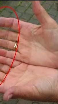 【レイノー現象】「しもやけ」ではなく、膠原病のサインだった！