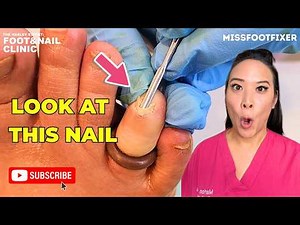 Infected Toenail Removal | Full Nail Extraction Procedure by Miss Foot Fixer Marion Yau