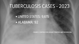 What are the symptoms of tuberculosis? Who should get tested for TB?