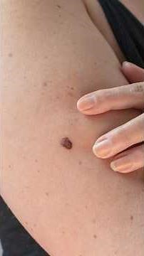 What does melanoma look like? ABCDE warning signs explained
