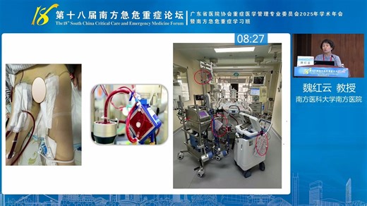 ECMO联合IABP的监护及安全管理 魏红云