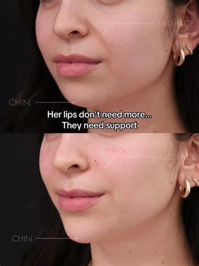 Lower Face Balancing Explained | Why Her Lips Finally Look Cohesive