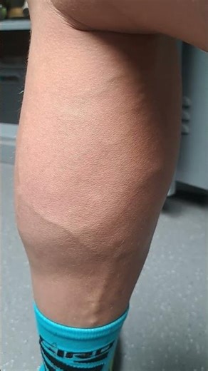 Leg Muscle fibres twitching after cycling race