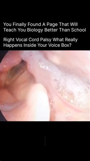 BIOLOGY | MEDICAL | HEALTH on Instagram: "When the right vocal cord becomes weak or can’t move, your voice changes instantly — it may sound breathy, hoarse, or low in power. That’s because the vocal cords can’t come together properly, leaving a gap where air escapes every time you speak. ✨ What Causes It? Injury to the recurrent laryngeal nerve Thyroid or neck surgery Viral infections Tumors pressing on the nerve Trauma or idiopathic (unknown cause) DM for credit/removal #RightVocalCordPalsy #Vo