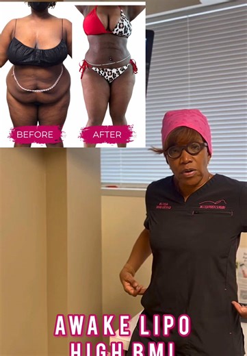 Awake Liposuction for High BMI Patients: Discover Results
