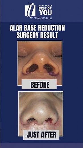 Before-After Result Alar Base Reduction Surgery | Fix wide nostrils with Rhinoplasty | Dr. PK Talwar