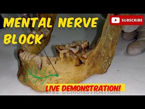 Mastering the Mental Nerve Block: Achieve a 95% Success Rate!!!
