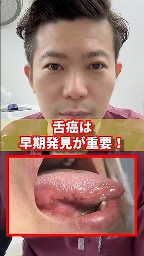 Early detection is crucial for tongue cancer! [Dentist]