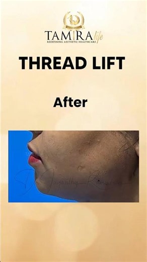 Thread Lift Before and After | Non-Surgical Face Lift Results..! | Tamira Life | Chennai