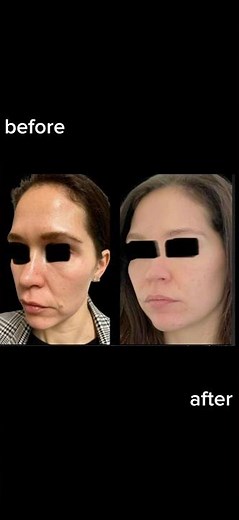 Filler From YOUR own Blood? 😳🩸 PRP gel filler explained: GRWM edition