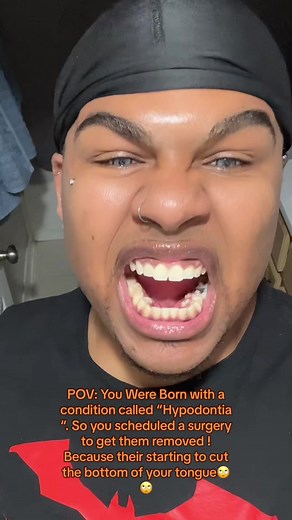 Understanding Hyperdontia: Tooth Extraction and Cure