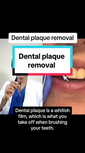 Effective Dental Plaque Removal Techniques for Healthy Teeth