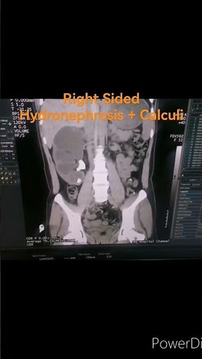 How CT KUB view | Hydronephrosis | Renal Calculi | CT KUB | Coronal view