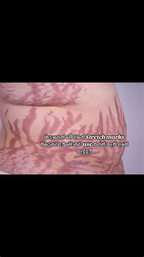 Effective Stretch Marks Removal Cream Review