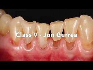 Composite resin Class V restoration