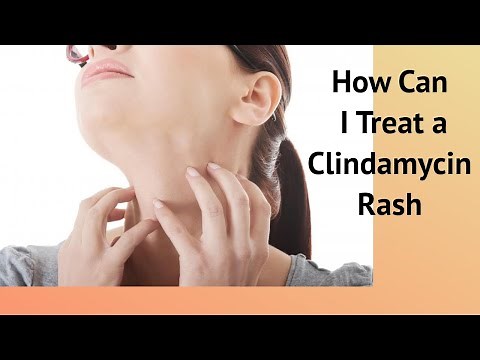 How Can I Treat a Clindamycin Rash