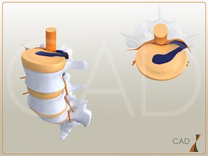 Arthrodèse lombaire mini-invasive par voie postérieure - Centre Aquitain du dos