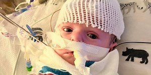 Kentucky baby has had 4 open-heart surgeries