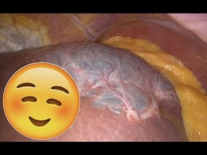 LES TUMEURS HÉPATIQUES BÉNIGNES