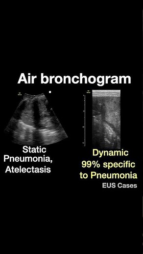 Air Bronchogram Lung Ultrasound