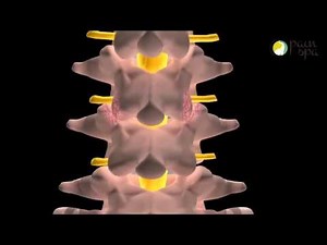Lumbar facet joint injection under X-ray Guidance