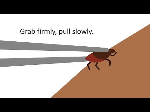 How to Remove a Tick