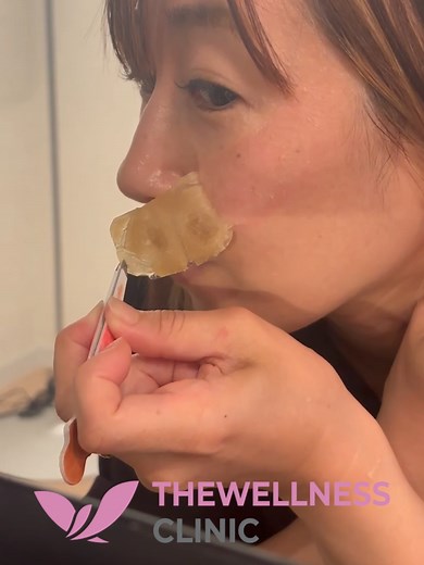 リポットレーザーによるしみ治療の効果と体験