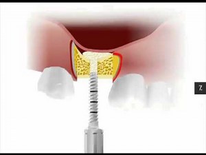 Bone compression kit Sinus augmentation technique mp4