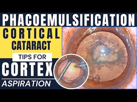 Phacoemulsification in soft nucleus and tips for cortical wash: Dr. Deepak Megur