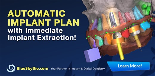 Watch the Automatic Implant Plan with Immediate Implant Extraction! | Blue Sky Bio