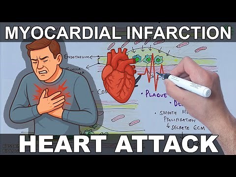 Myocardial Infarction | Heart Attack