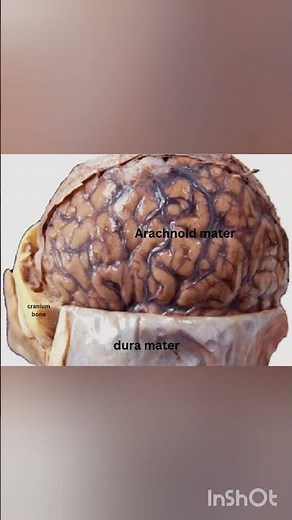 dura mater , arachnoid mater and cranium bone |Explained