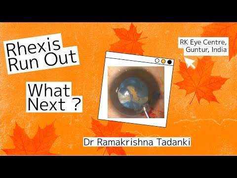 Rhexis Run Out in Intumescent Cataract - What Next ? Dr Ramakrishna Tadanki
