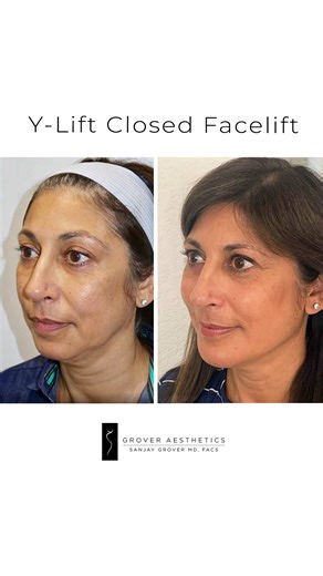 Sanjay Grover MD, FACS on Instagram: "This is a Before and After of a patient recently treated. She underwent a non-surgical Y LIFT ‘Liquid Facelift’ in just 1 hour under local anesthesia. This procedure enhanced her lower jawline which created the appearance of having had a facelift. Would you believe there were no incisions? The post picture is one month following the treatment. ✨ #nonsurgicalfacelift #nonsurgicalfacelifts #facelift #liquidfacelift #sanjaygrovermd"
